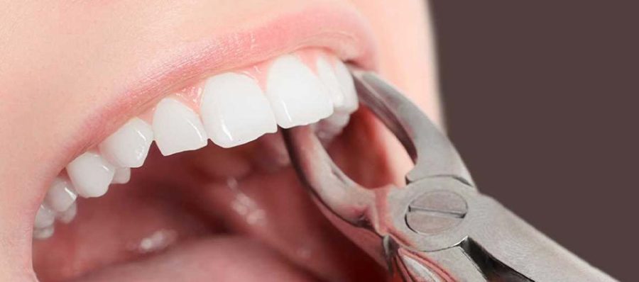 Cerrahi 20’lik Diş Çekimi Ücreti