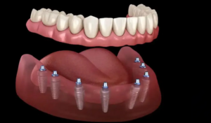 Ağrısız implant diş