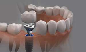 Söğütlüçeşme implant yapan klinikler