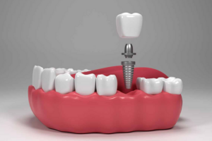 Küçükçekmece'de implant yaptırmadan önce bilinmesi gerekenler