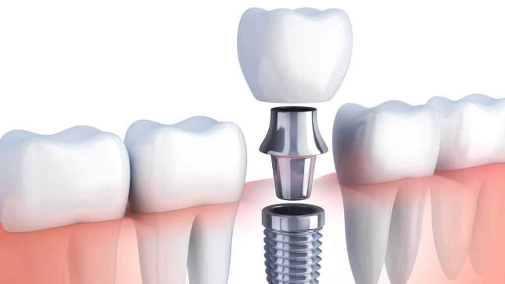 Küçükçekmece implant