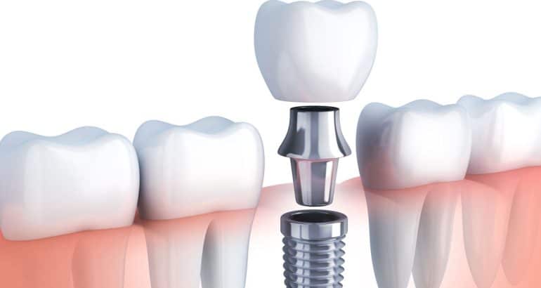 Küçükçekmece implant diş hekimi
