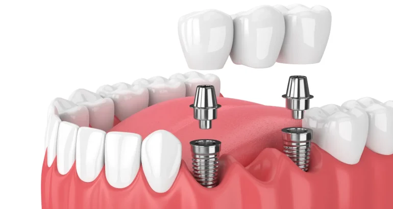 Küçükçekmece implant kliniği