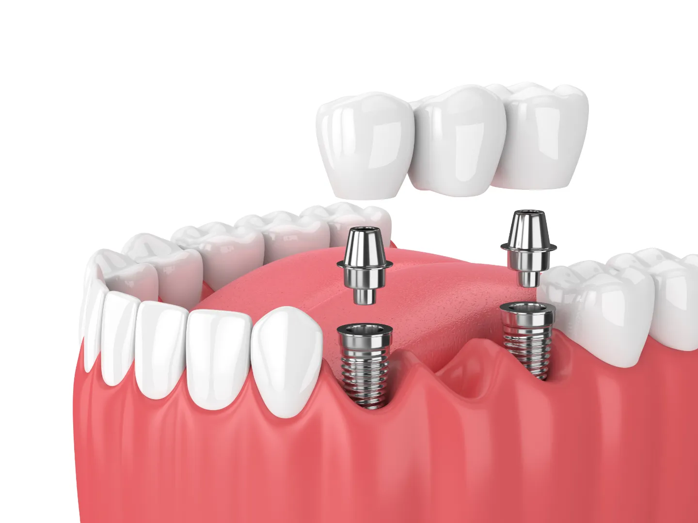 Halkalı implant fiyatları