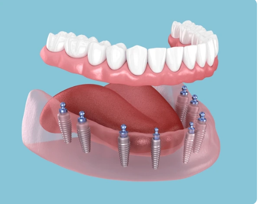İlk implant muayenesinde neler yapılır?