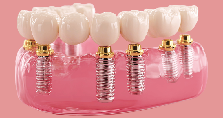 Küçükçekmece implant tedavisi